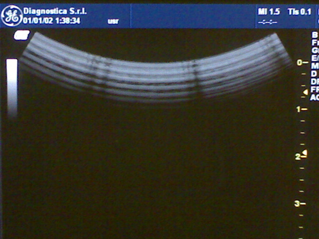 guasto al BeamFormer oppure alla sonda